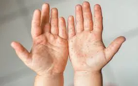 El contacto provoca el contagio del síndrome de mano pie boca