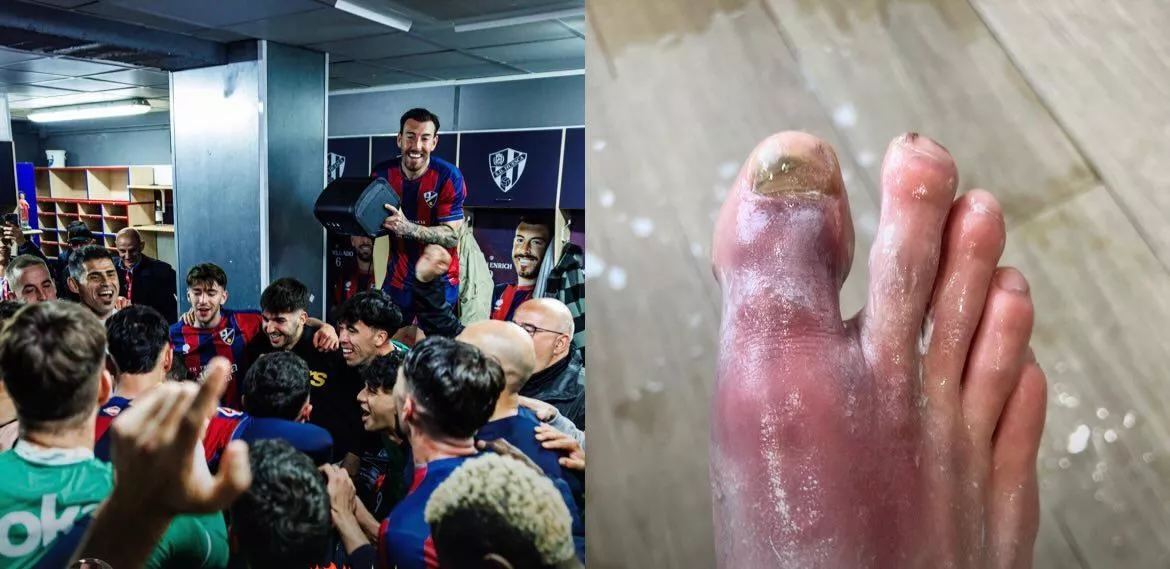 Una imagen dolorosa: el mermado pie de Sergi Enrich tras el Huesca-Málaga