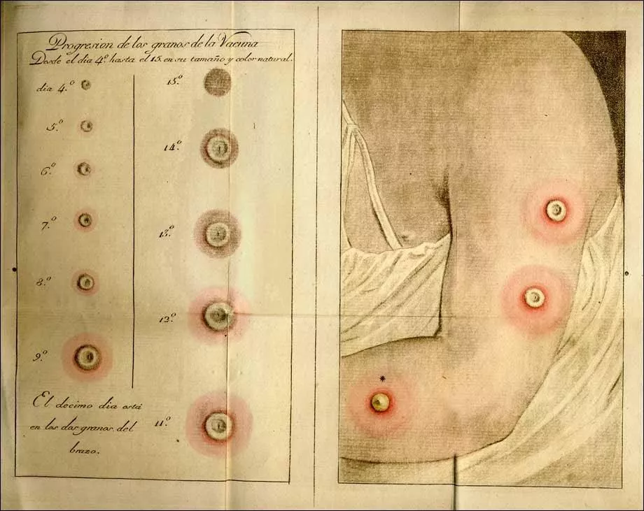 Orencio Antonio de Santolaria y Ramirez, un Sertoriano propagador de la vacuna antivariólica de Balmis Orencio Antonio de Santolaria y Ramirez, un Sertoriano propagador de la vacuna antivariólica de Balmis