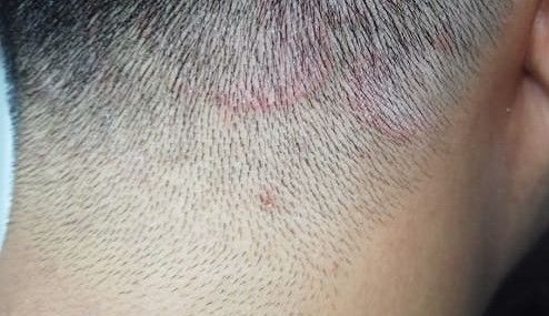 Los peluqueros rechazan la generalización sobre el brote de tiña