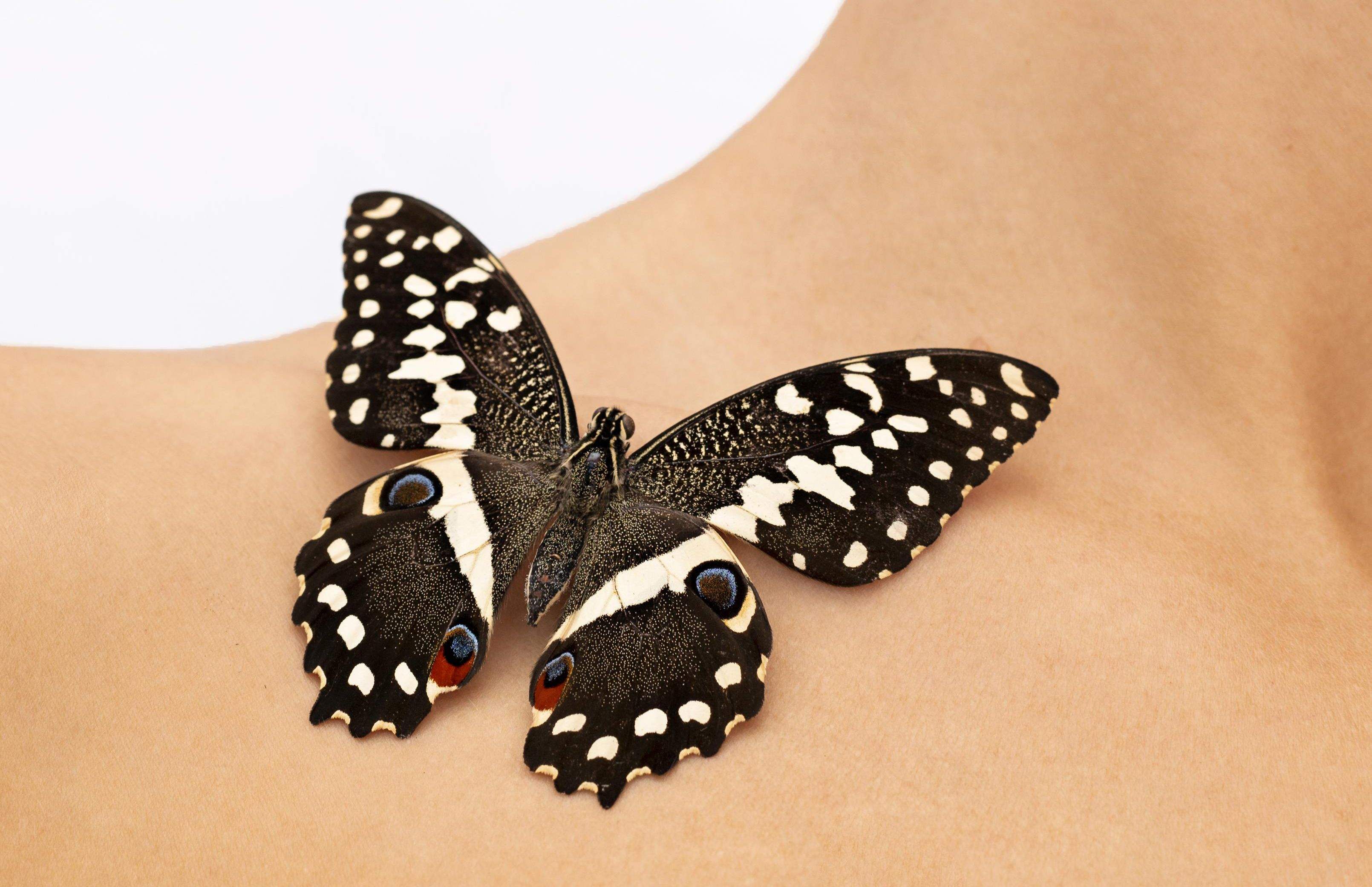 La enfermedad 'Piel de Mariposa' no tiene cura y requiere tratamientos médicos diarios.